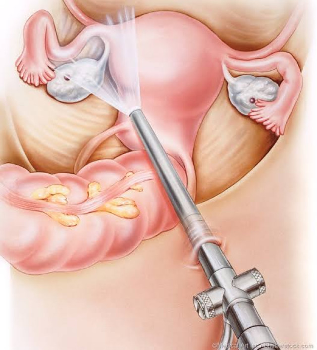 Laparoscopy illustration showing the ovaries, fallopian tubes, uterus, and colon.